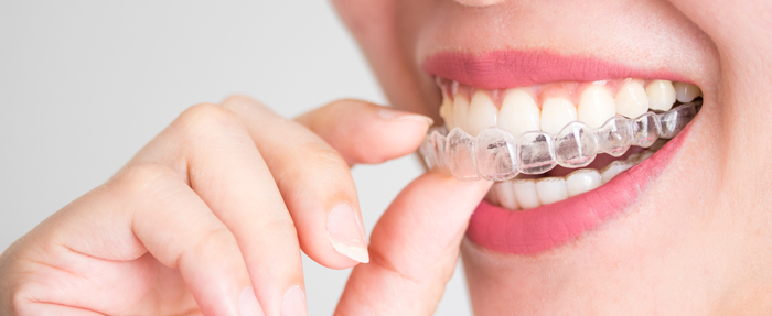 Trommeter Orthodontics | Close-up of a person inserting a clear orthodontic aligner onto their teeth.